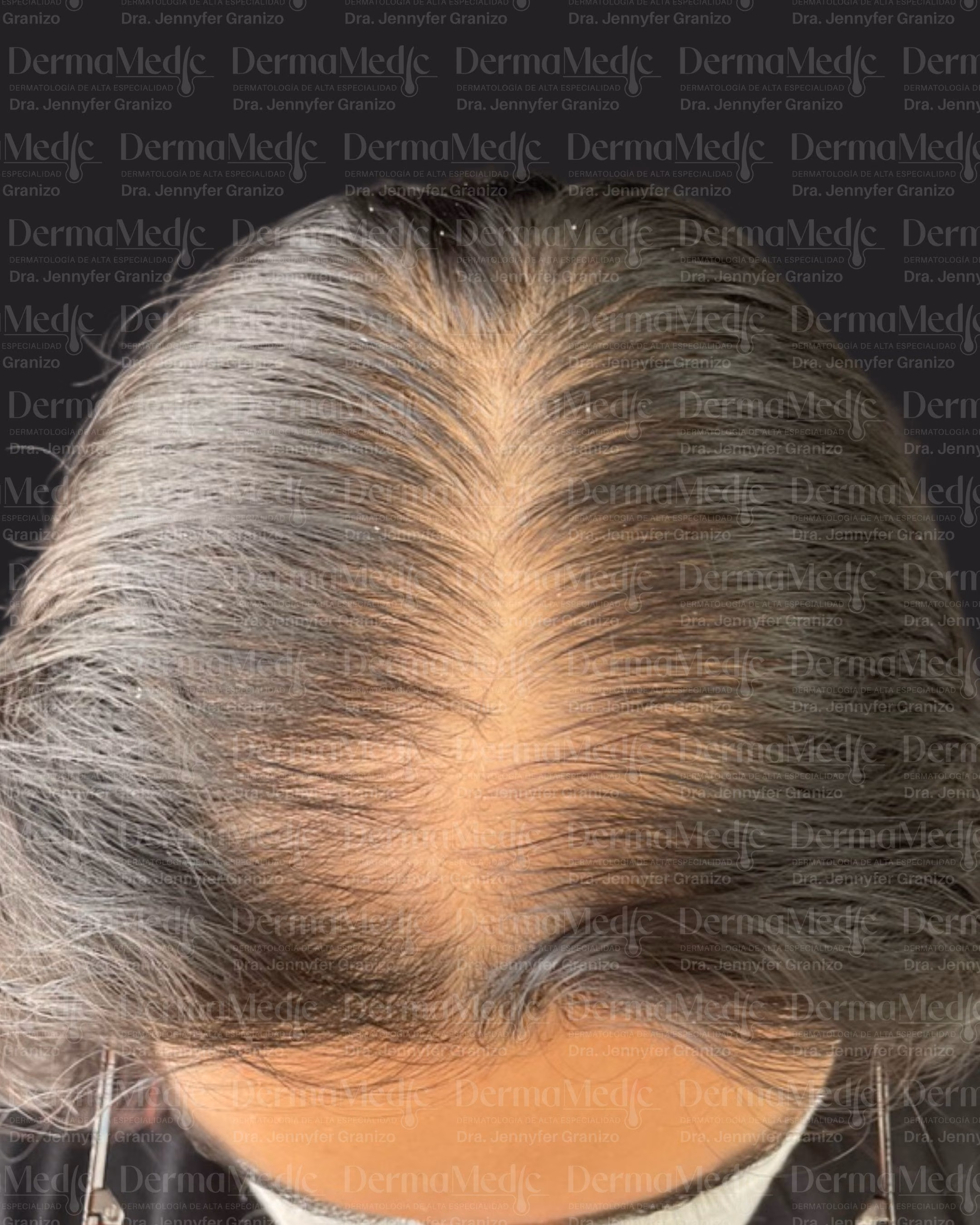 Alopecia · Trasplante capilar