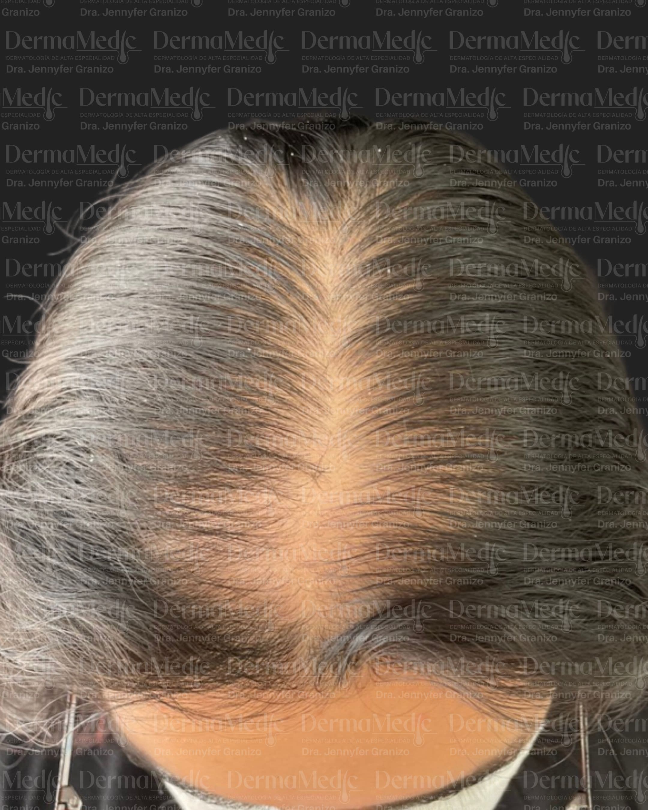 Alopecia · Trasplante capilar
