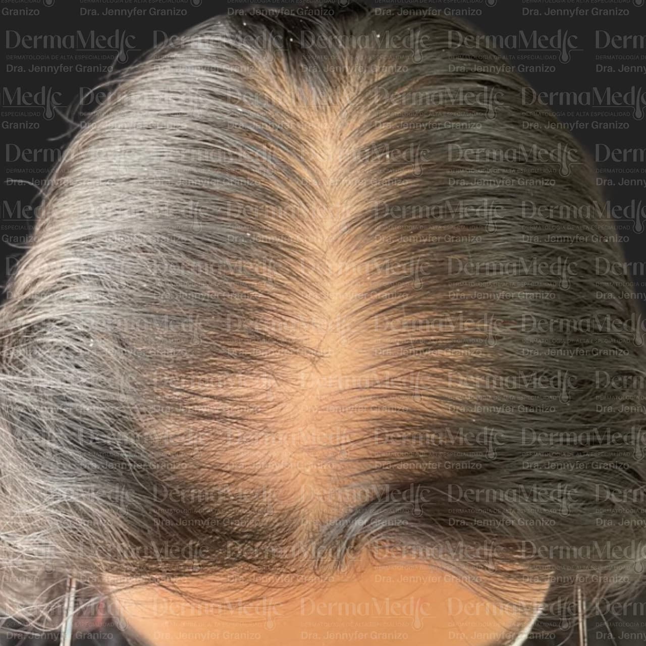 Alopecia · Trasplante capilar